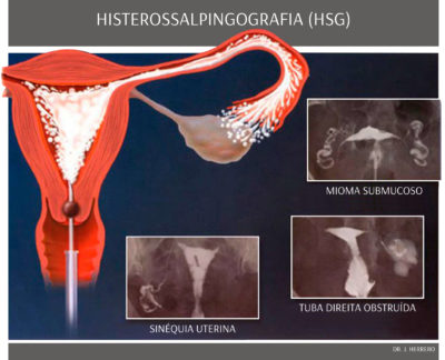Fertilidade - Histerossonografia