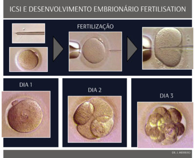 Tratamentos - ICSI Desenvolvimento Embrionário Fertilisation