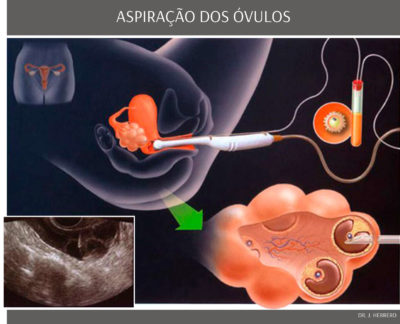 Tratamentos - Aspiração Óvulos