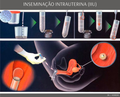 Inseminação Intrauterina (IIU)